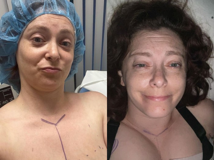 Woman With Dramatically Uneven Breasts Gets Surgery to Correct Them on  Botched By Nature