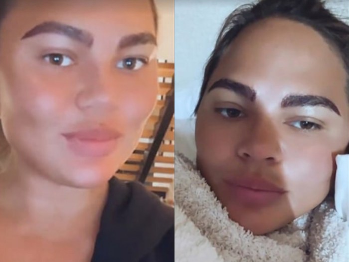 Chrissy Teigen Before and After: Did the Model Get Plastic Surgery?