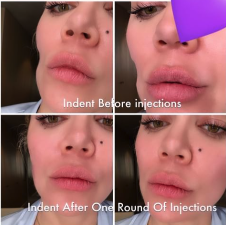 lip injections before and after